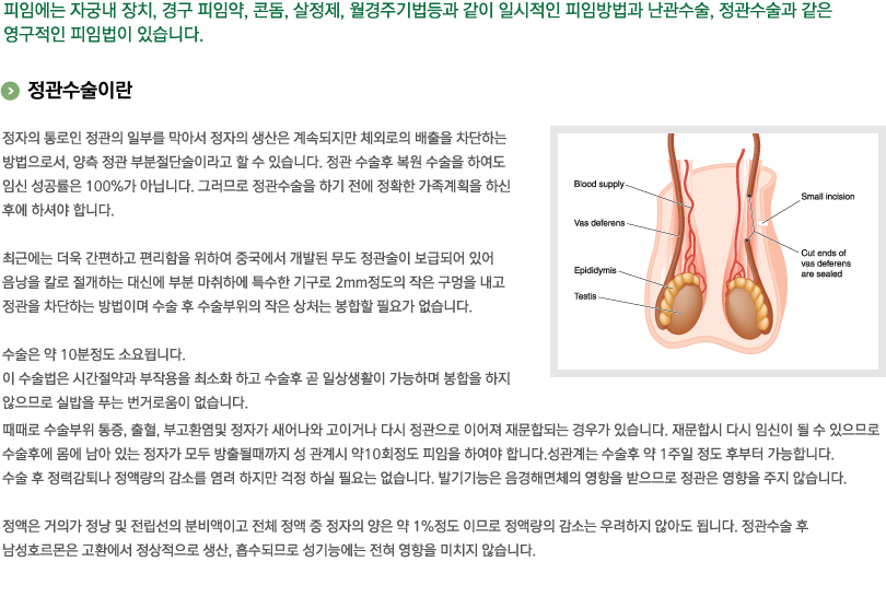 정관수술이란