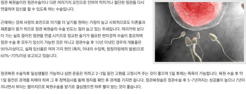 정관복원수술이란