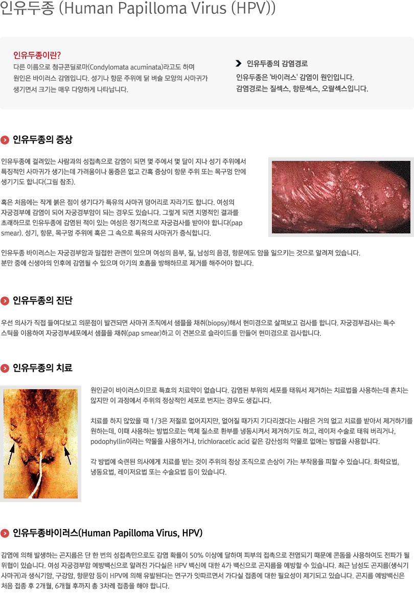 인유두종