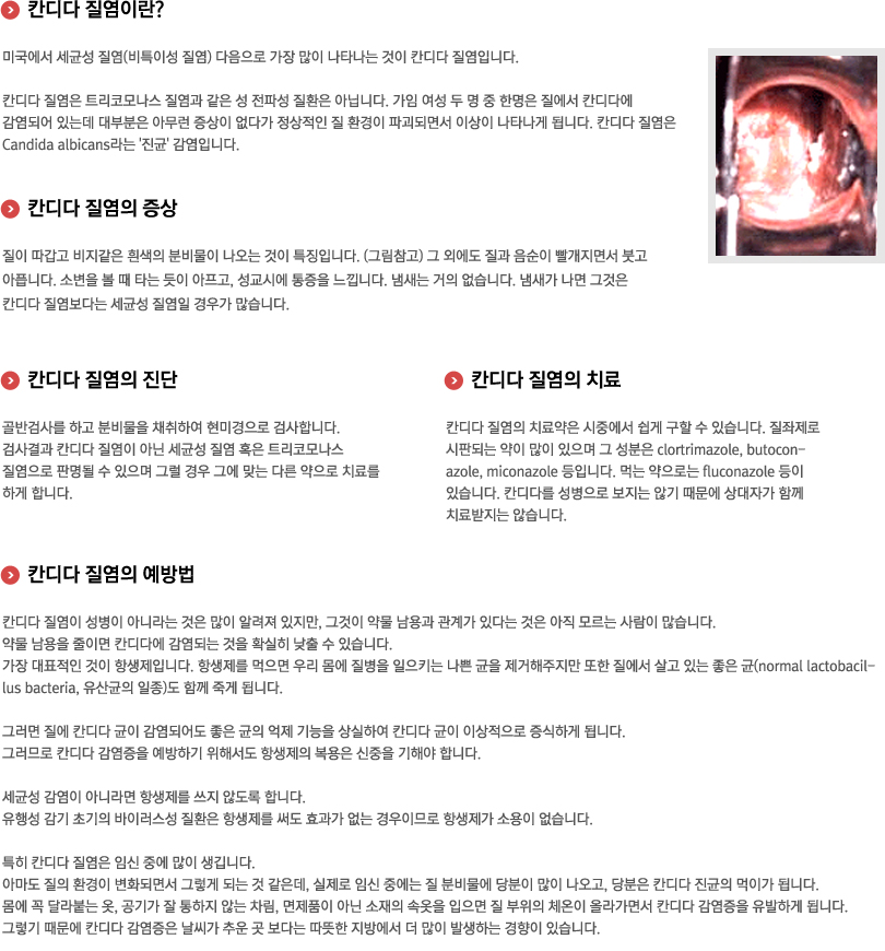 칸디다질염