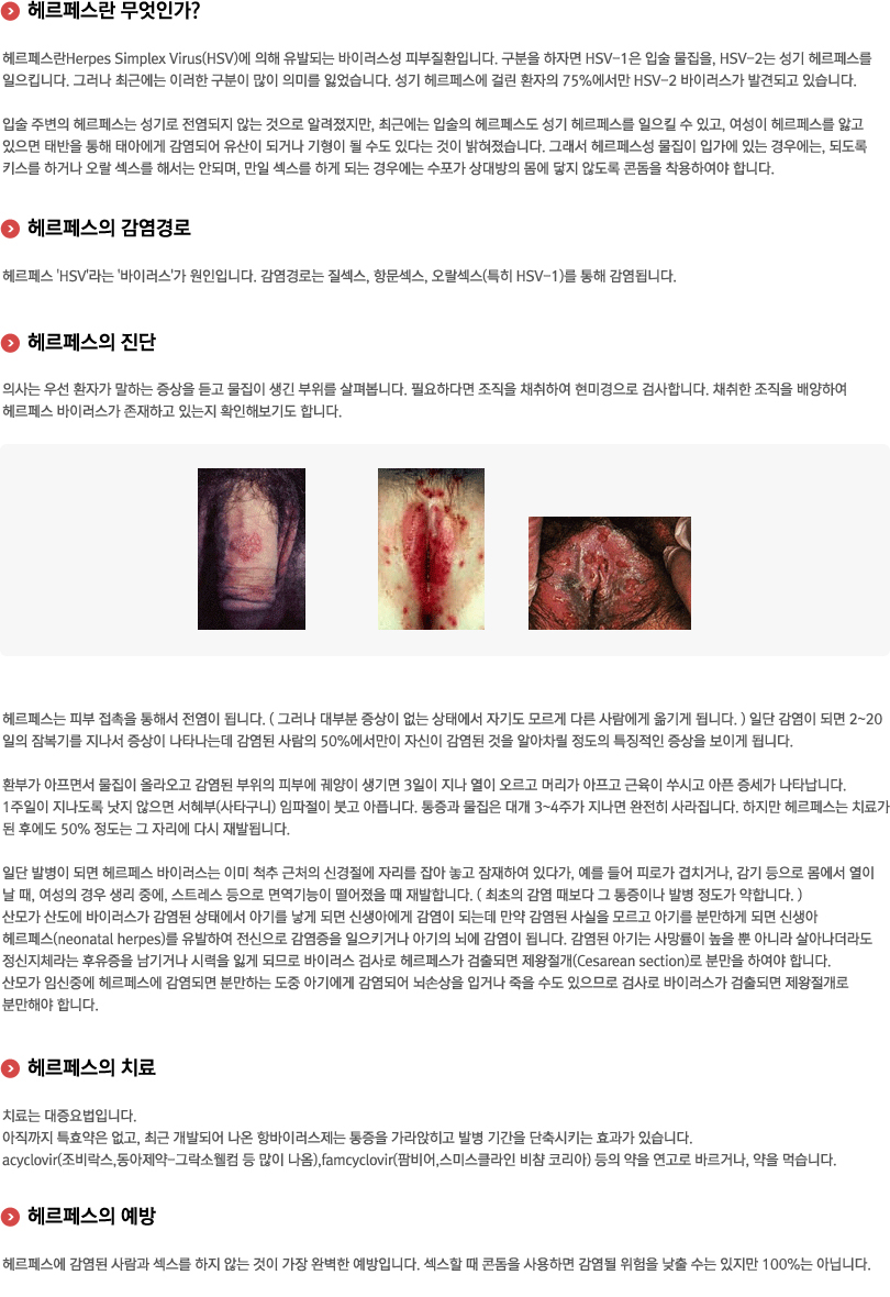 헤르페스